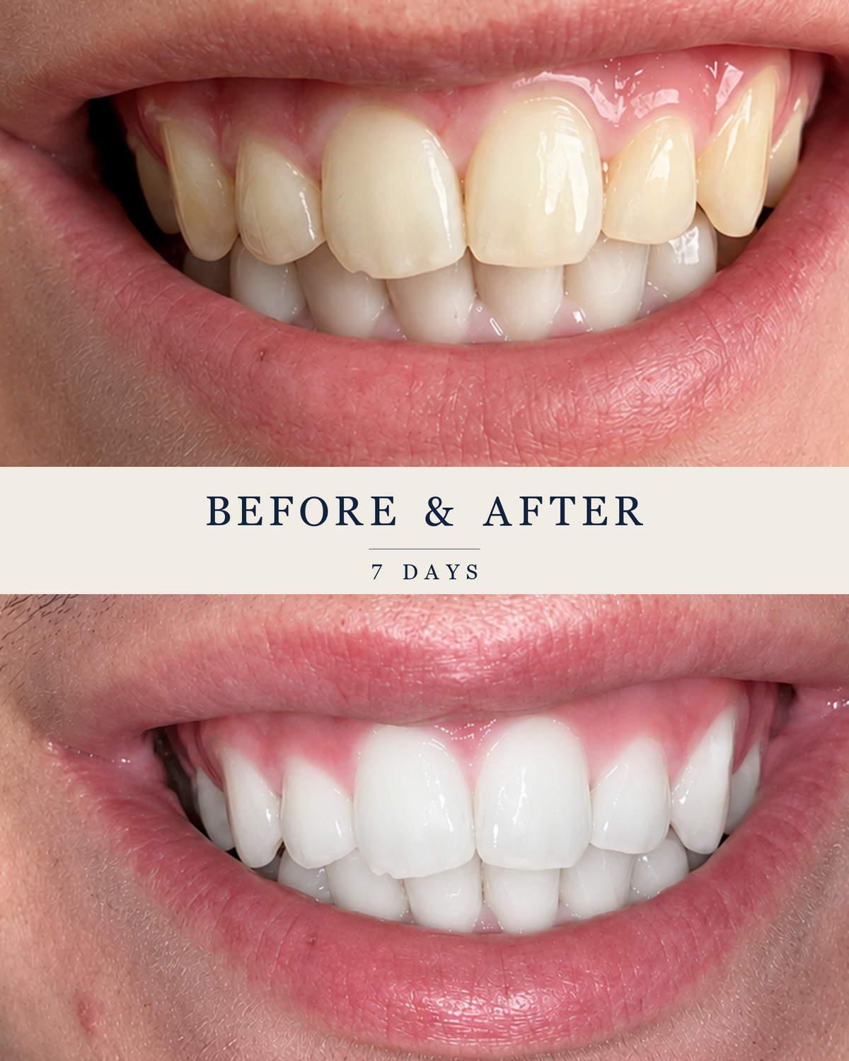 A SmilePro customer's smile before and after a seven-day course of SmilePro whitening treatments